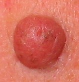 moles-and-skin-tags-growing-during-pregnancy.jpg